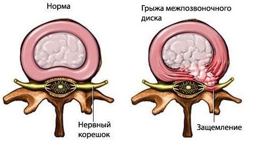 Грыжа в межпозвонковых дисках Грыжа в межпозвонковых дисках