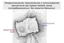 Лапароскопическая герниопластика Лапароскопическая герниопластика