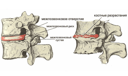Межпозвоночная грыжа диска Межпозвоночная грыжа диска