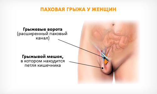 Паховая грыжа у женщин Паховая грыжа у женщин
