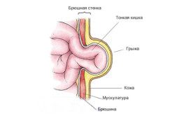 Схема пупочной грыжи у младенца Схема пупочной грыжи у младенца
