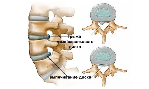 Межпозвоночная грыжа Межпозвоночная грыжа