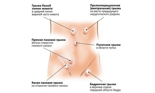 Основные виды грыж Основные виды грыж