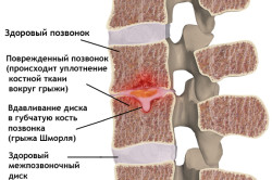 Расположение грыжи Шморля Расположение грыжи Шморля