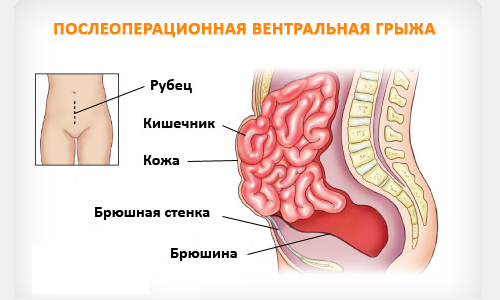 Изображение послеоперационной вентральной грыжи Изображение послеоперационной вентральной грыжи