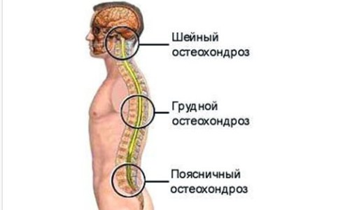 Очаги возникновения остеохондроза Очаги возникновения остеохондроза