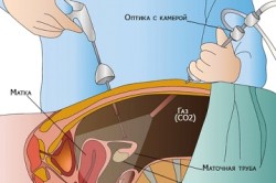 Лапароскопия грыжи паховой области Лапароскопия грыжи паховой области