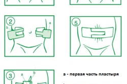 Наклеивание пупочного пластыря Наклеивание пупочного пластыря