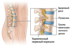 Схема грыжи позвоночника Схема грыжи позвоночника