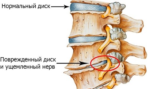 Позвоночник при остеохондрозе Позвоночник при остеохондрозе