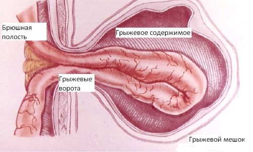 Принципиальная схема грыжи Принципиальная схема грыжи