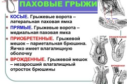 Виды паховых грыж Виды паховых грыж