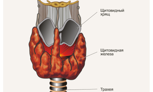 Симптомы и причины узлового зоба щитовидной железы