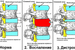 Схематическое изображение двух стадий остеохондроза
