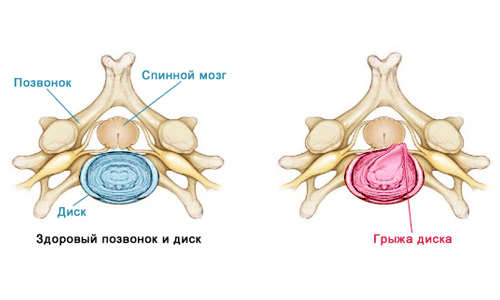 Фораминальная грыжа диска позвоночника