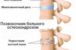Клинические особенности остеохондроза