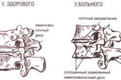 Схема здорового и больного остеохондрозом позвонков