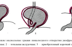 Скользящие аксиальные грыжи