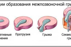 Стадии образования грыжи
