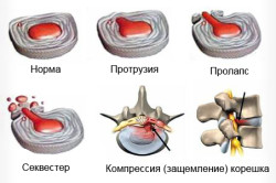 Стадии межпозвоночной грыжи