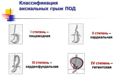 Степени нарастания аксиального выпячивания