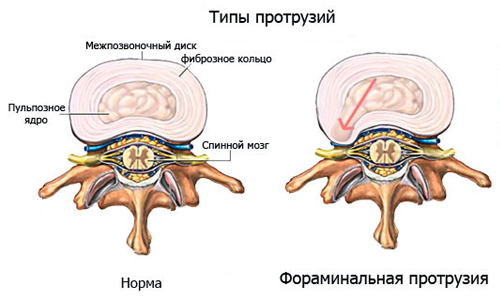 Операция по замене межпозвоночного диска