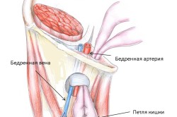 Схема бедренной грыжи