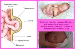Грыжа у новорожденных детей