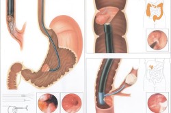 Эзофагоскопия пищевода