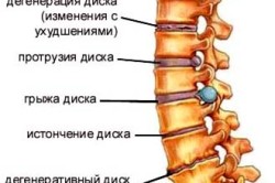 Грыжа межпозвонковая