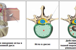 Лечение межпозвоночной грыжи лазером