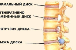 Клинические проявления протрузии дисков