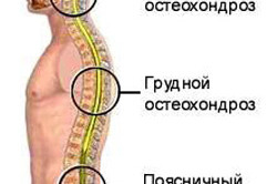 Локализация остеохондроза по отделам позвоночника