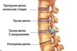 Стадии повреждения позвоночника при остеохондрозе