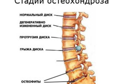 Стадии остеохондроза