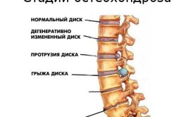 Стадии остеохондроза
