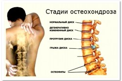 Стадии остеохондроза