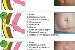 Стадии образования грыжи живота