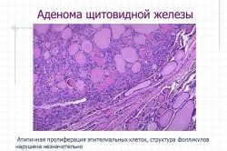 Схема аденомы щитовидной железы