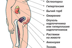 Симптомы болезни Иценко-Кушинга