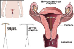 Внутриматочная спираль - причина эндометрита