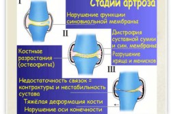 Стадии развития артроза